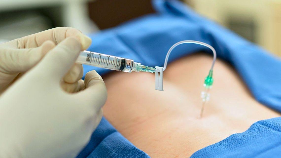 Epidural Injection for Back Pain