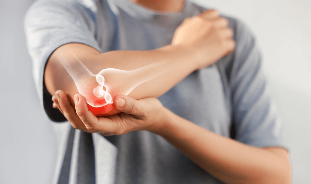 Complex Regional Pain Syndrome