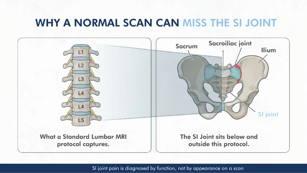why a standard lumbar MRI can miss sacroiliac joint pain